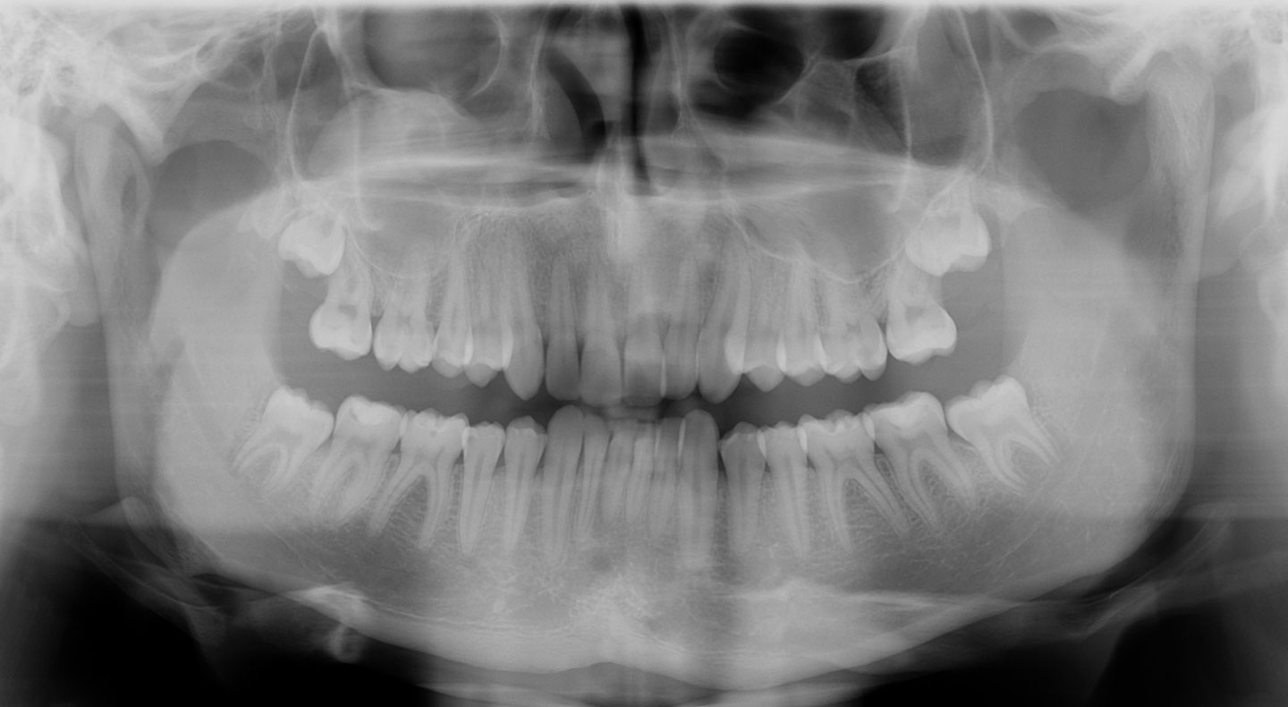 Панорамный снимок челюсти
