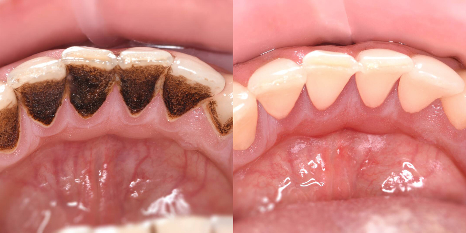 Профессиональная гигиена полости рта