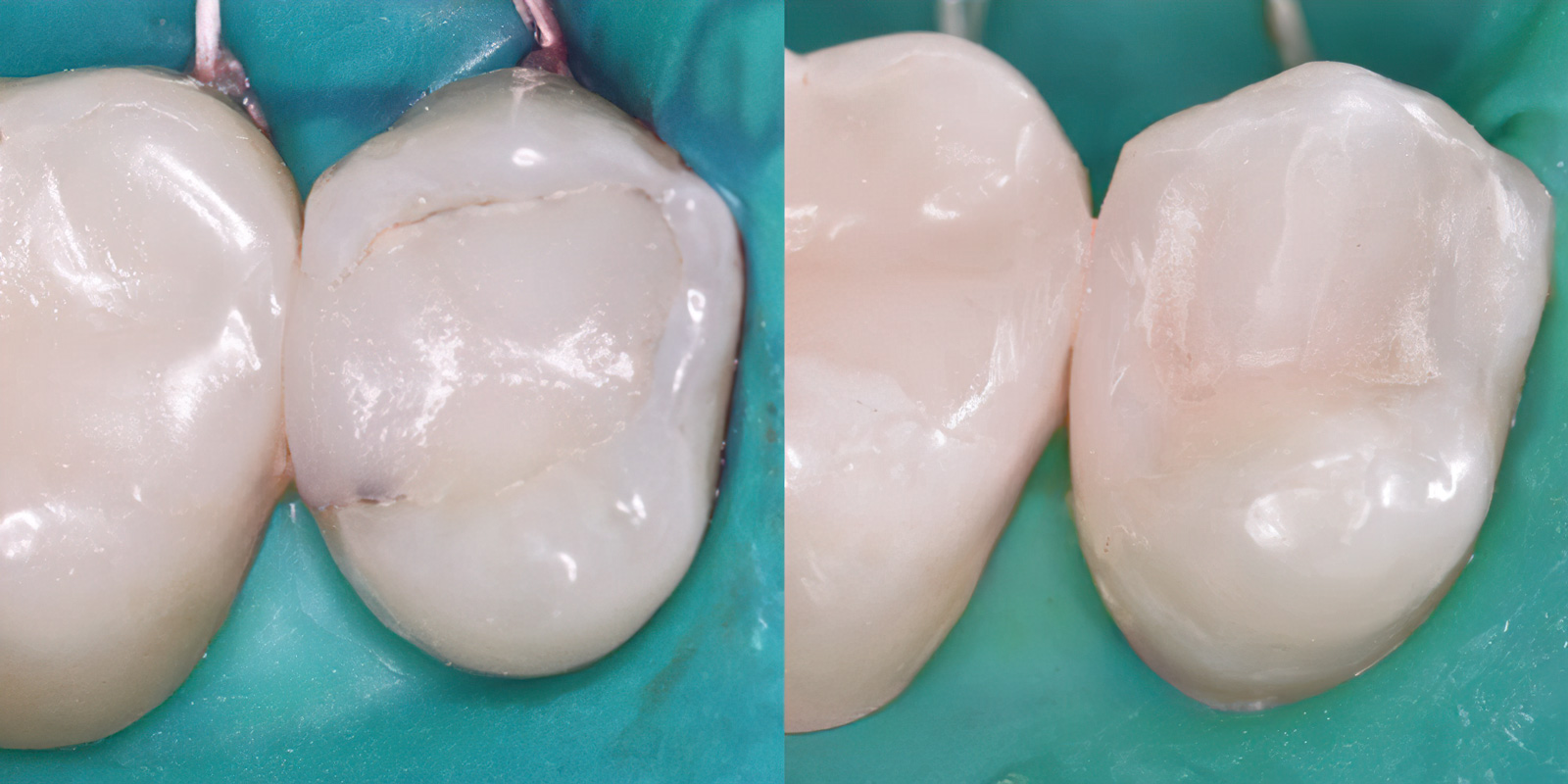 лечение вторичного кариеса