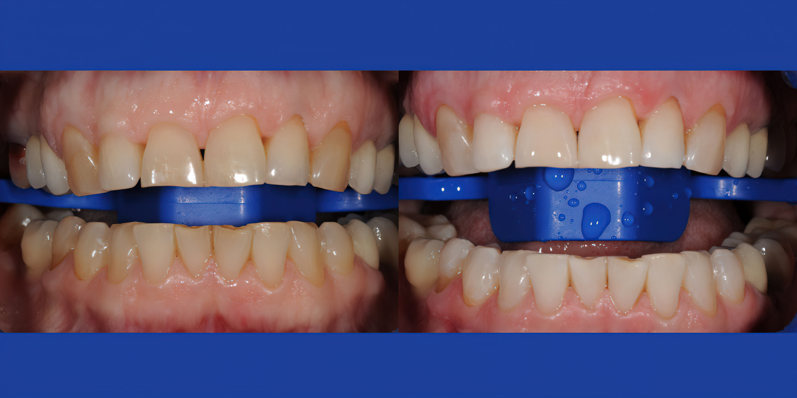 Безопасное отбеливание фото