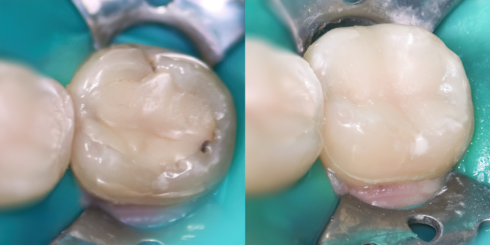 вторичный кариес